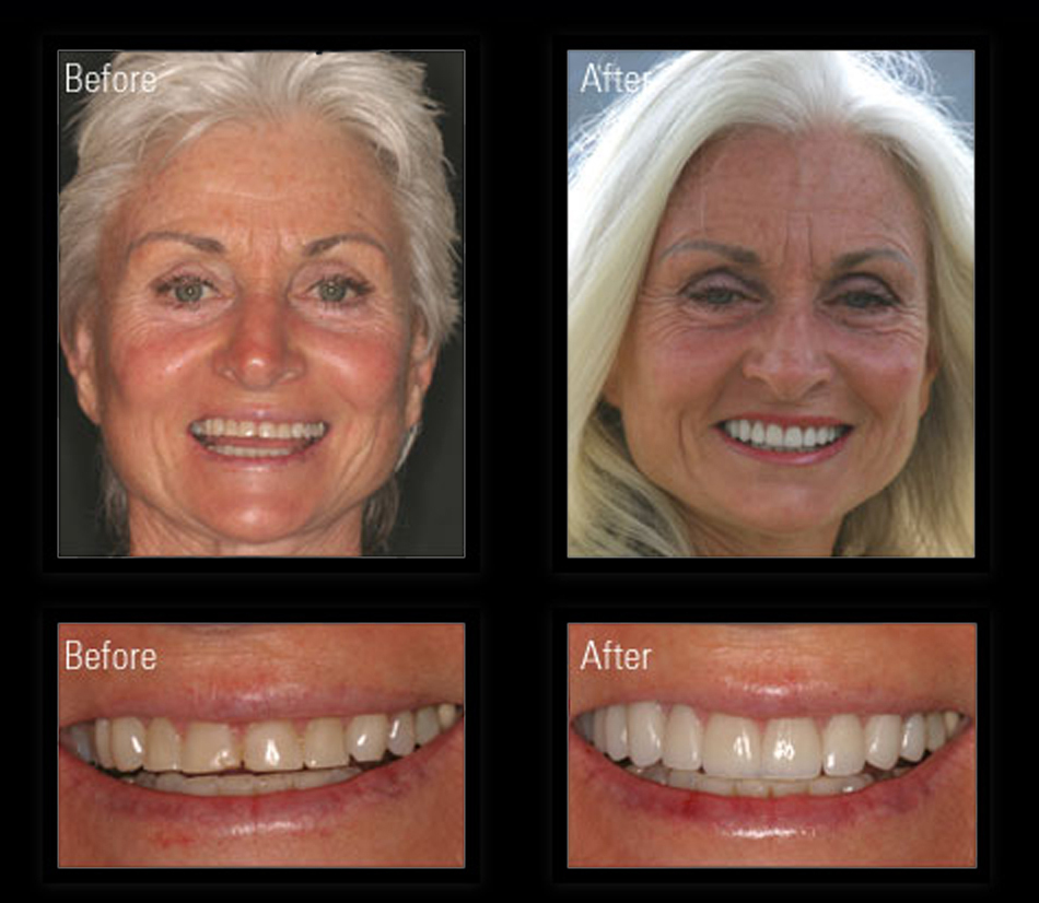 zoom teeth whitening los angeles