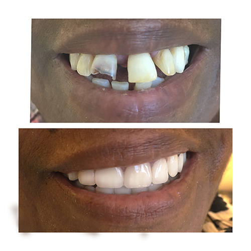 zoom teeth whitening los angeles